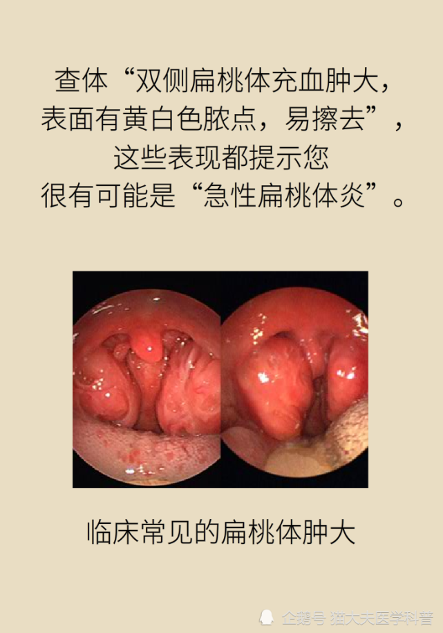 扁桃体一侧肿大比两侧肿大更凶险,多半是恶性肿瘤!