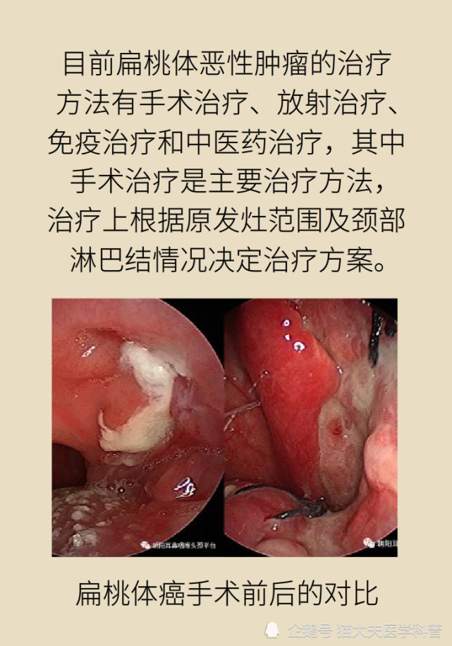 扁桃体一侧肿大比两侧肿大更凶险,多半是恶性肿瘤!
