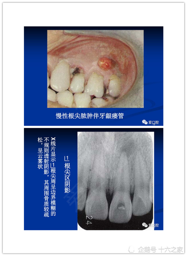 口腔根尖周炎的发病机制详解