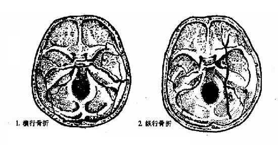 颅骨骨折应该接受哪些检查