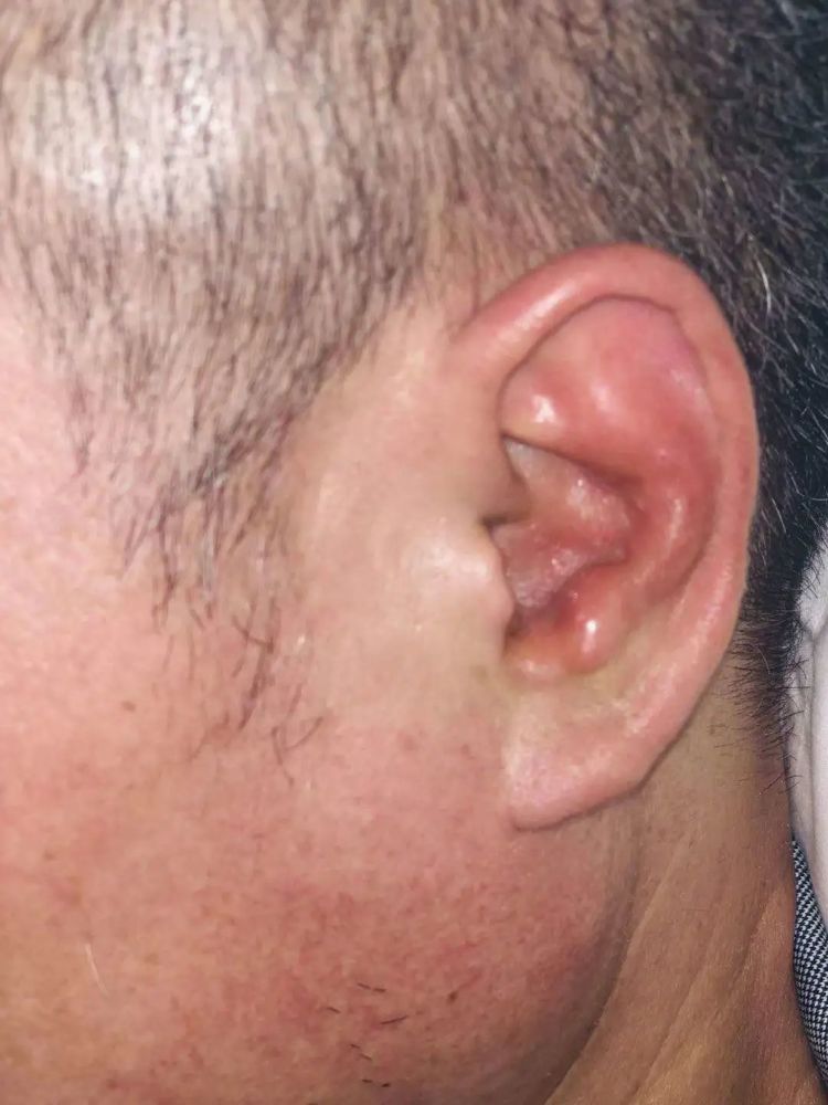 吃了几天消炎药后,症状不但没好转,反而在耳朵周围出现了一些疱疹