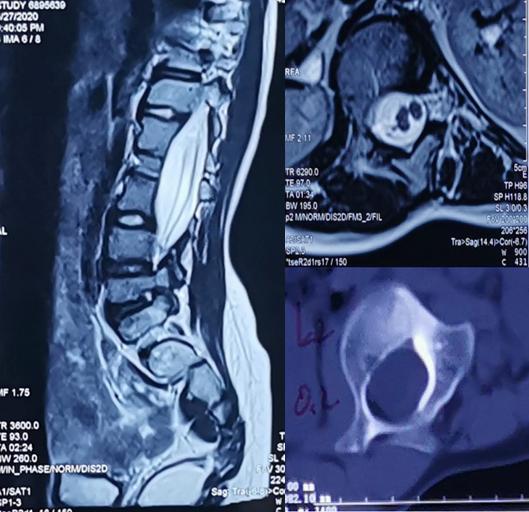 手术治疗先天性脊柱侧凸畸形 脊髓纵裂病例分享