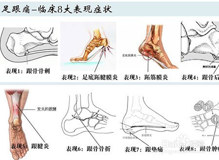 肾虚的那点事-烦人的足跟痛