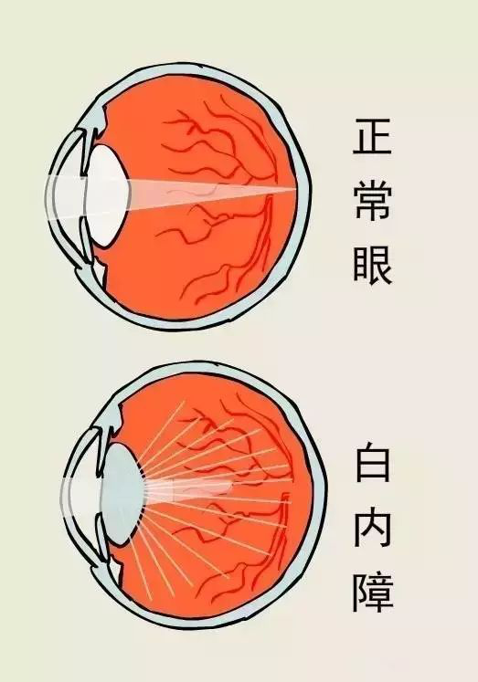 白内障的早期症状