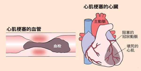 急性心肌梗死,记住两个"120"很重要!