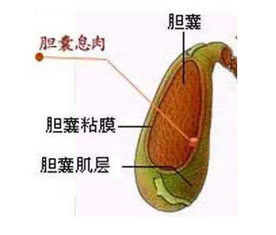 胆囊息肉恶变率高吗