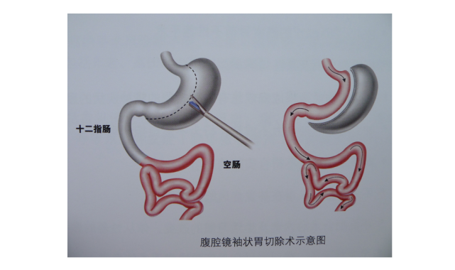 知名经纪人公开做切胃手术没有胃怎么进食这就告诉你