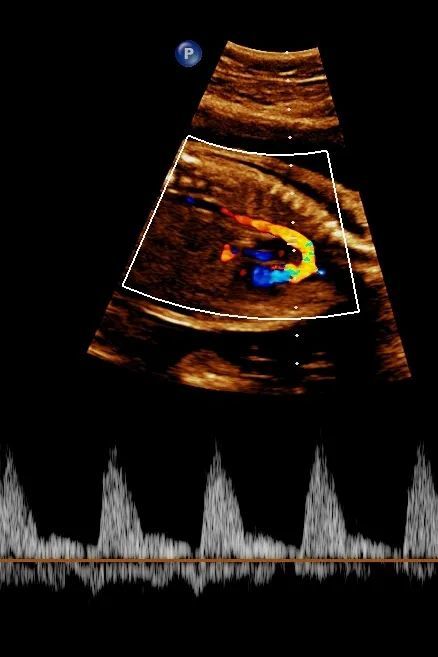胎儿超声心动图知多少?