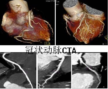 冠状动脉cta|冠状动脉|胸部|缺血性心肌病|冠心病