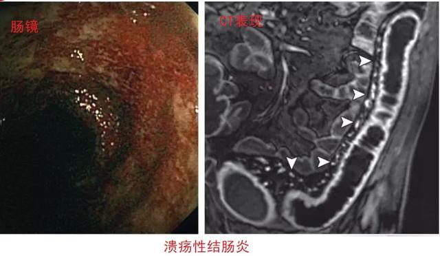 溃疡性大肠炎,是发生于大肠的一种以溃疡糜烂为主的炎性疾病,故而得名