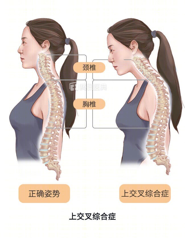 随着头前伸,颈椎变形的不断加剧,胸椎的生理曲度也会发生变化,出现后