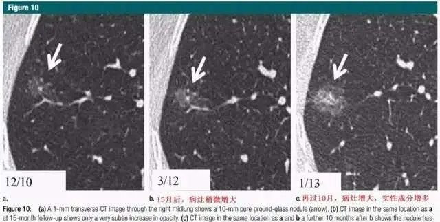 肺磨玻璃结节该手术还是随访?医生主要看这几点