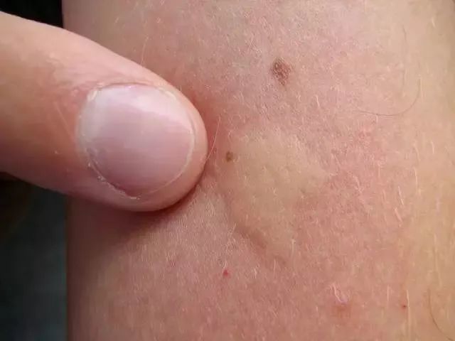 (点击空白处查看虫咬性皮炎症状) 图片来源网络 图片来源 zj.