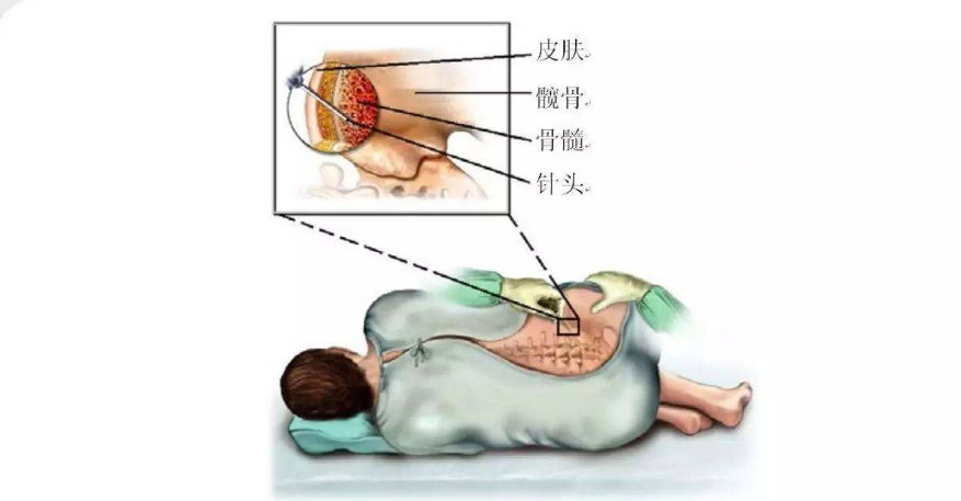 骨穿活检主要是检查什么