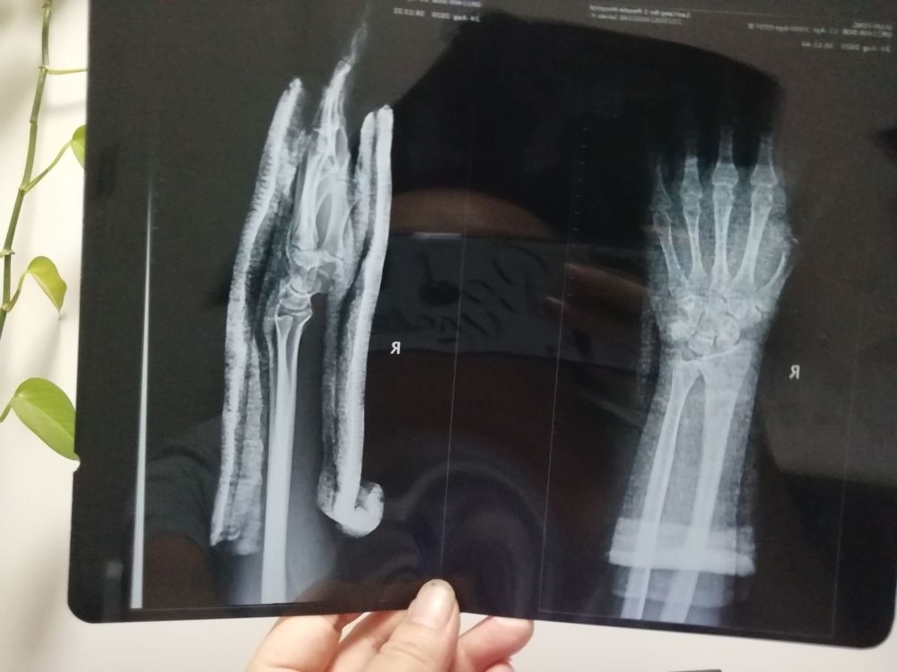 右手骨折,洛阳医院狂给完好的左手拍片子,神操作患者欲哭无泪