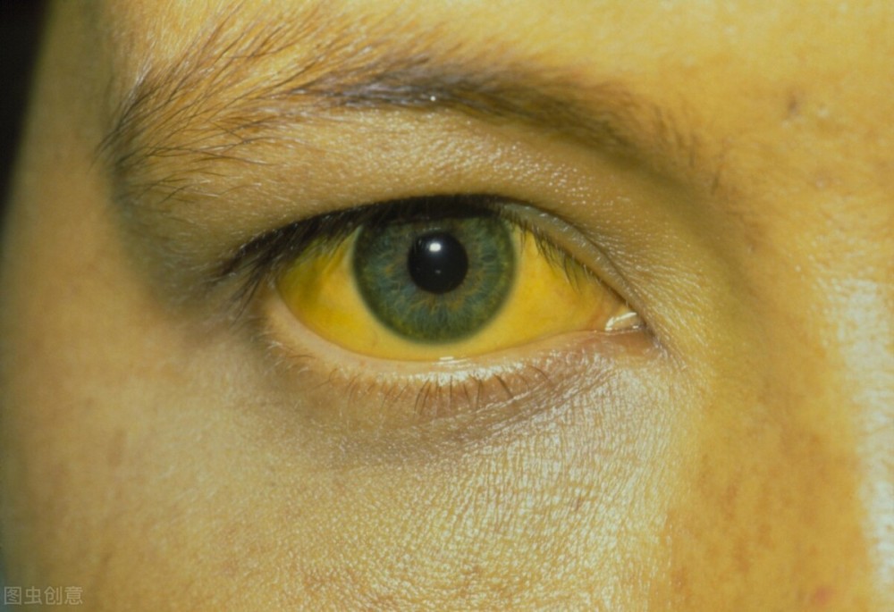 眼白发黄是肝病的"信号"?提醒:这4大常见诱因要警惕