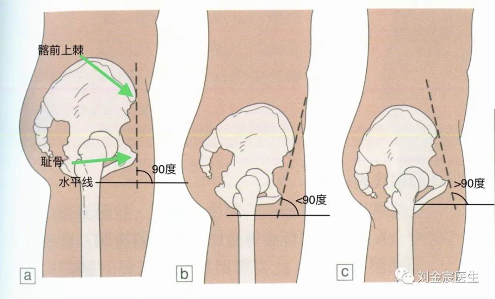 健康的骨盆位置是骨盆处于中立位,在站立时,从侧面观看,髂前上棘与