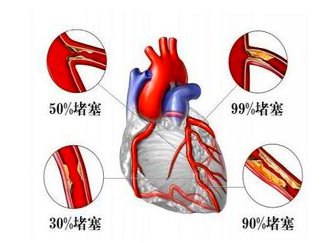 冠状动脉堵塞了多少算是冠心病?