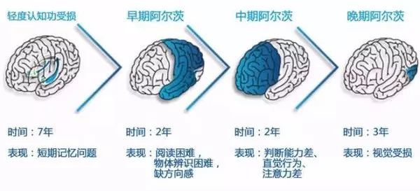 得了"阿尔茨海默病"该怎么办?之科普讲堂—第三集