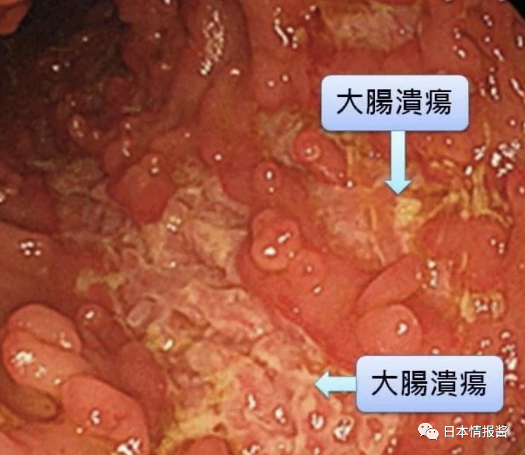 攻击自己的大肠,使大肠产生发炎及溃疡的一种疾病