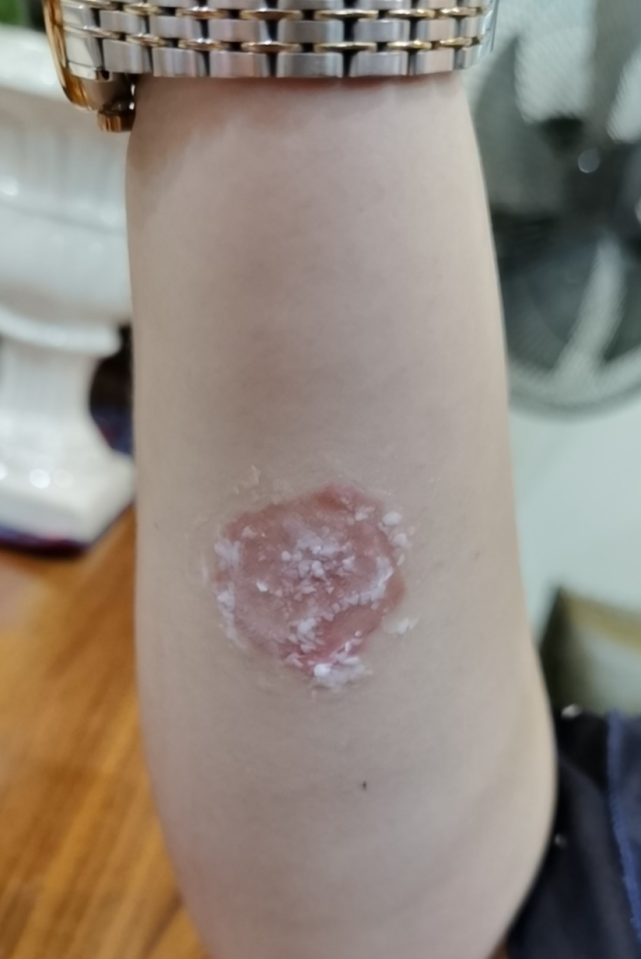 "困扰她的就是她右手的一块红斑——
