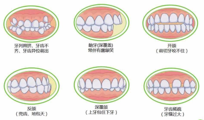 大连齿医生口腔 牙齿畸形,凸嘴该如何矫正?