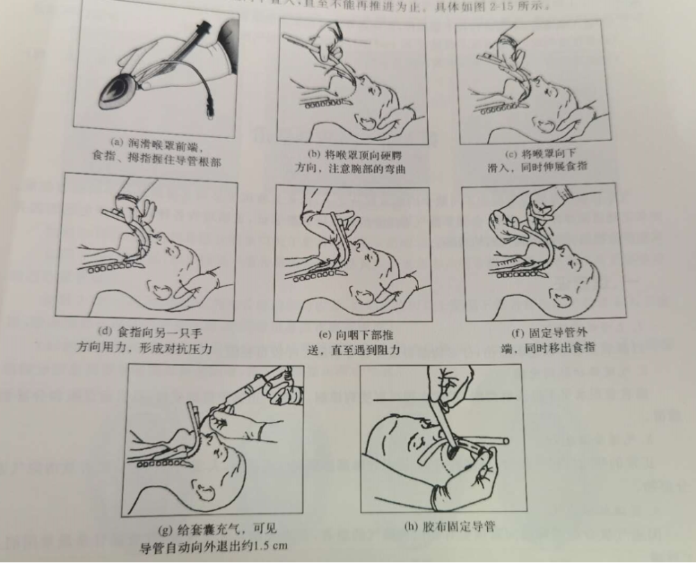 喉罩最佳位置:是指喉罩进入咽喉腔,罩的下端进入食管上口,罩的上端