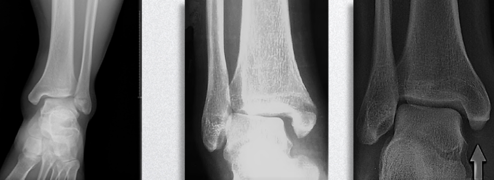 40% 踝内侧结构损伤 下胫腓联合损伤 骨间韧带损伤 高位腓骨骨折 主要