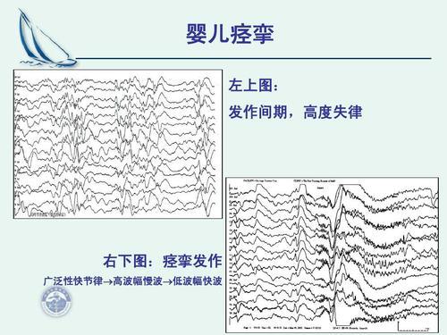 预后:婴儿痉挛常合并严重的智力发育和运动发育落后.