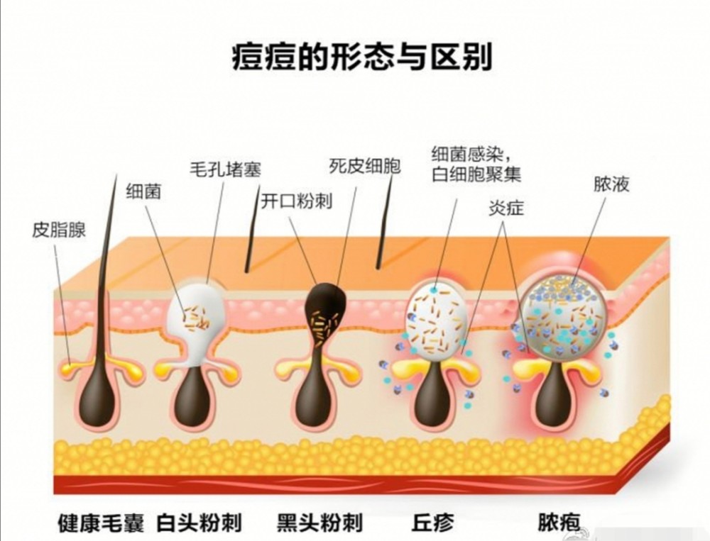 2,黑头粉刺型:属于开放性粉刺,位于毛囊口的顶端,可挤出硬脂栓.