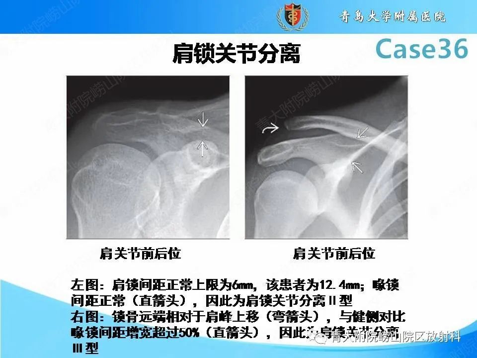 肩锁关节分离