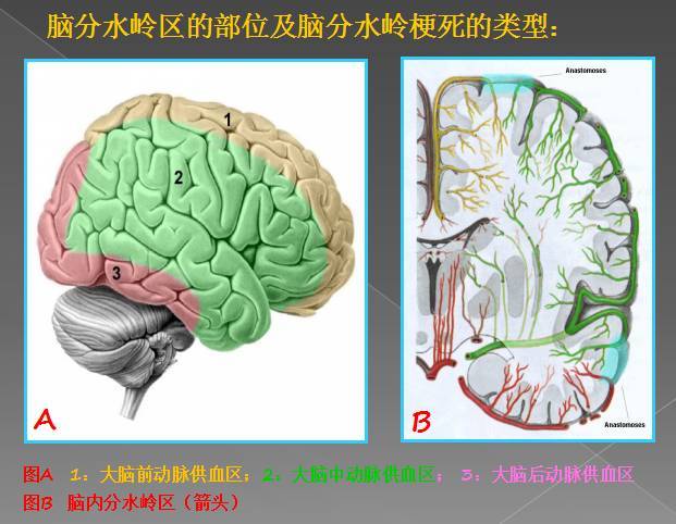 缺血性出血性分水岭腔隙性四大类脑梗的影像解读