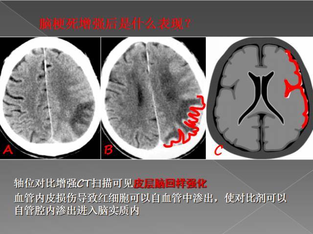 缺血性,出血性,分水岭,腔隙性四大类脑梗的影像解读