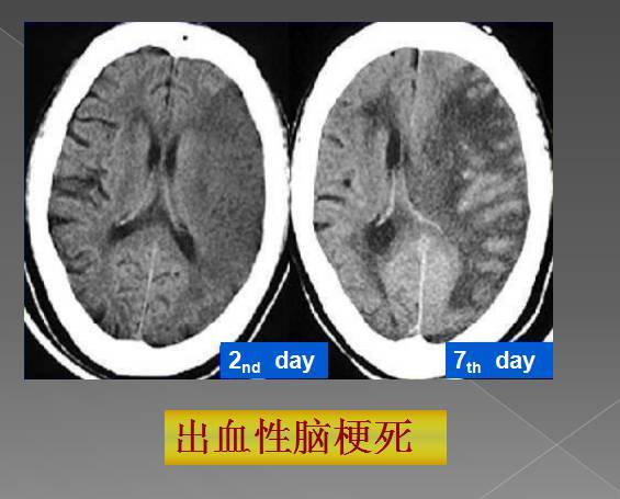 出血性,分水岭,腔隙性四大类脑梗的影像解读|缺血|急性脑梗塞|脑梗死