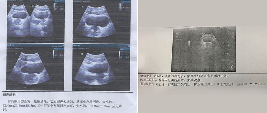 老中医|确诊前列腺钙化时他还没有症状,但他没有拖延,立即开始了治疗