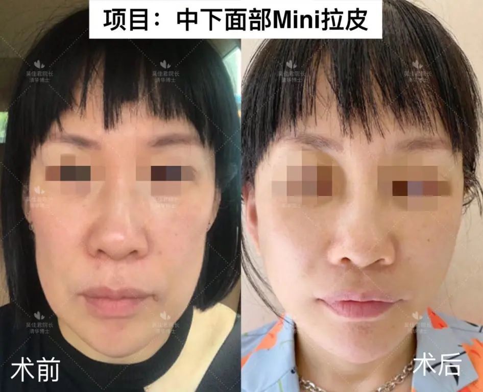 35-60岁做拉皮手术前,你需要弄清楚这6点