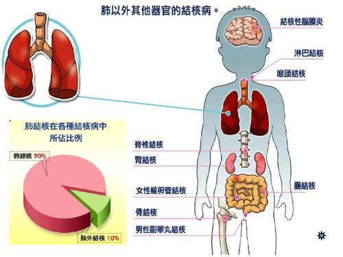 五,其他肺外结核:结核分枝杆菌通过通过呼吸系统感染而使人患肺结核病