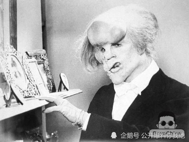 口味偏重真实版卡西莫多英国象人的悲剧一生