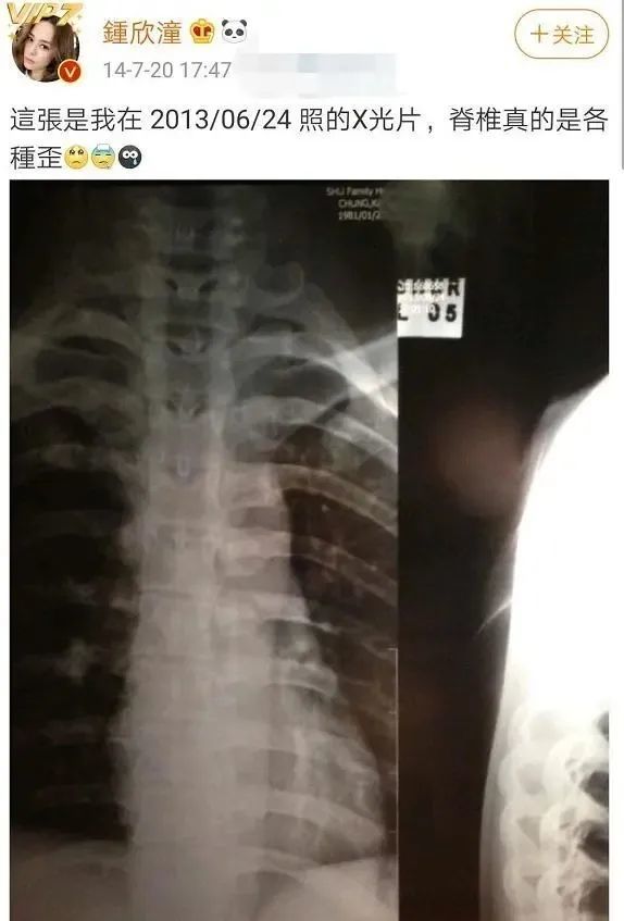 阿娇头部受伤或需二次手术凌晨突发昏厥撞伤伤口6cm缝合数十针