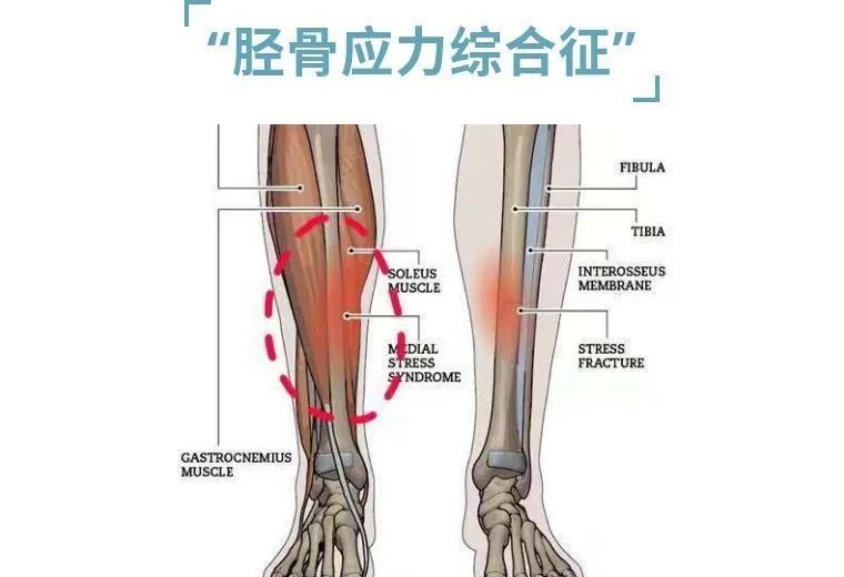 小腿迎面骨疼快来康康