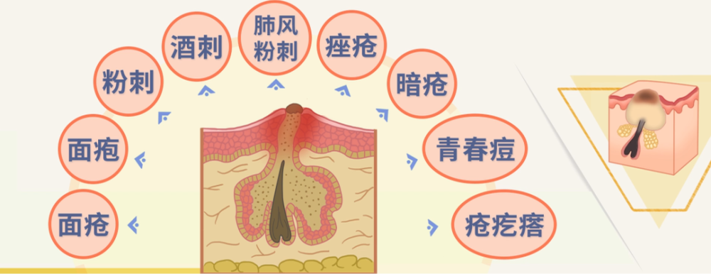 满脸痘痘老不好?外治内调是关键,看看中医如何治疗痘痘!