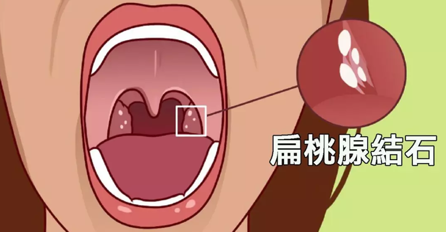 而扁桃体结石为什么会藏在如此隐秘的扁桃体窝中呢?