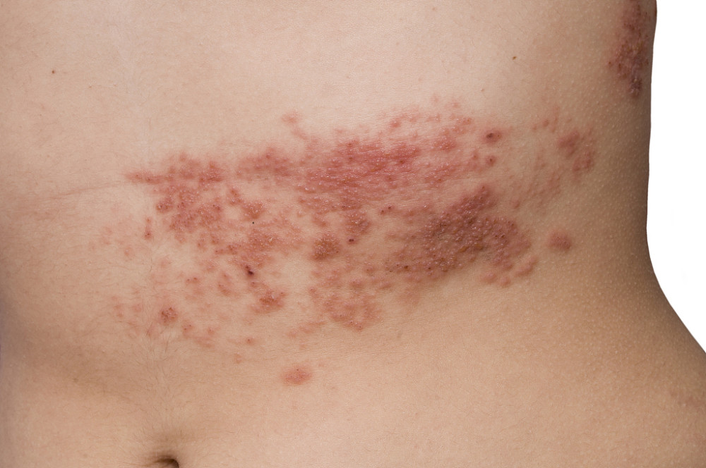 然而,很多人被带状疱疹影响皮肤有特殊表现,在病毒入侵后受到了感染