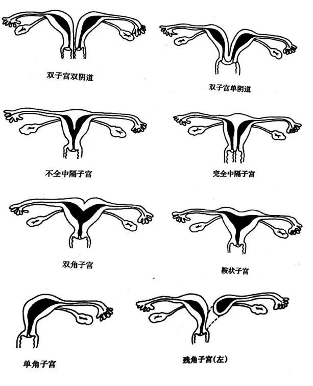 子宫发育不良(幼稚子宫),双子宫,双角子宫,鞍状子宫,中隔子宫(纵隔