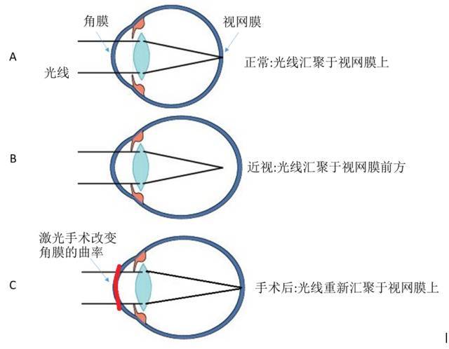 要不要做激光近视眼手术郑州视光专家我们用数据说话