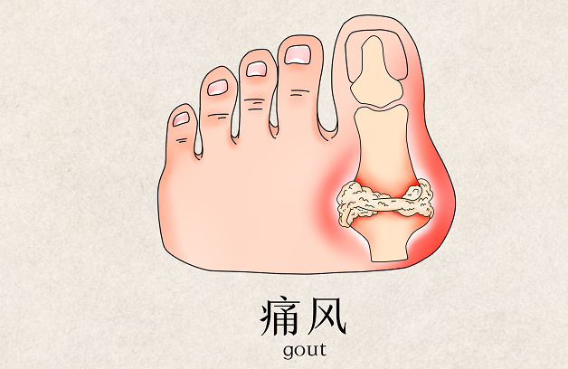 啤酒 海鲜=痛风套餐?真相来了!