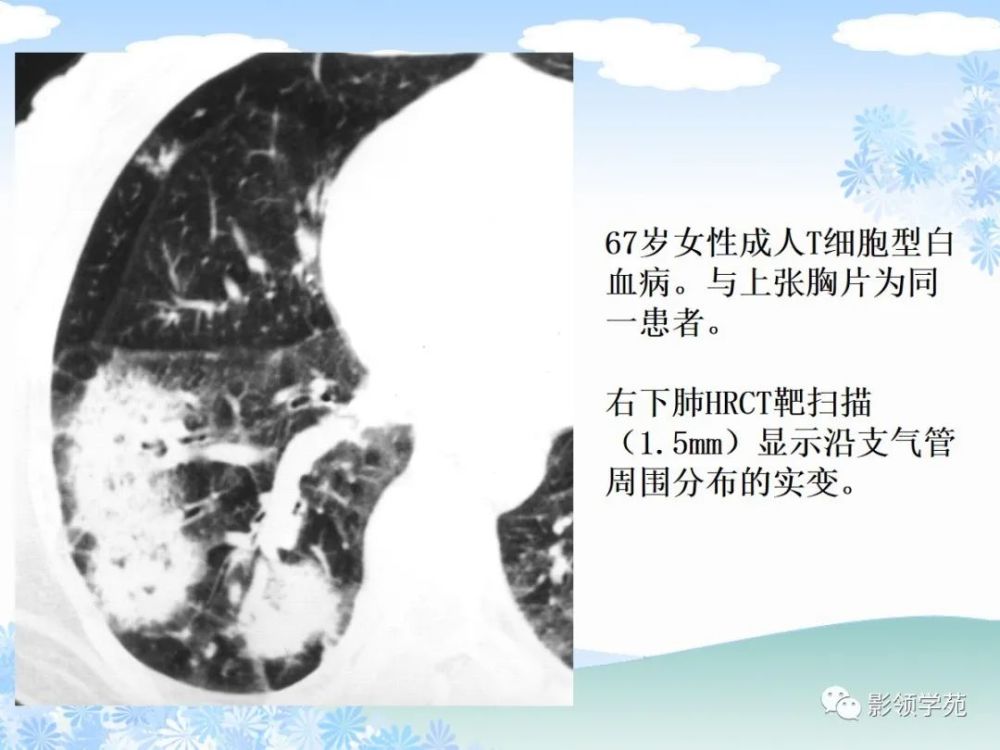 梳理清晰!白血病肺部浸润的ct诊断与鉴别