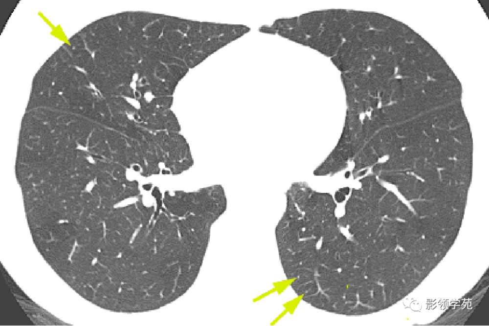 梳理清晰!白血病肺部浸润的ct诊断与鉴别