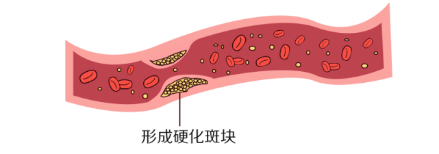 健康的血管血脂过多,会在血管壁上沉积,逐渐形成小斑块高血脂的危害我