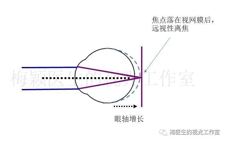 本案中,按等效球镜度计算,我们做的主觉验光结果比睫状肌麻痹验光更负